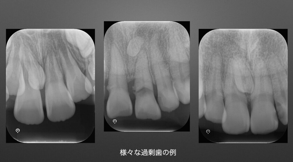 歯の数が多い…??過剰歯とは? | 医療法人フロンティア あま歯科クリニック